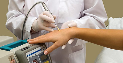 cryodermie krioterapia