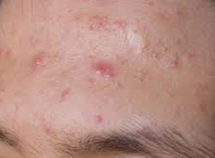 Skuteczne sposoby na walkę z trądzikiem