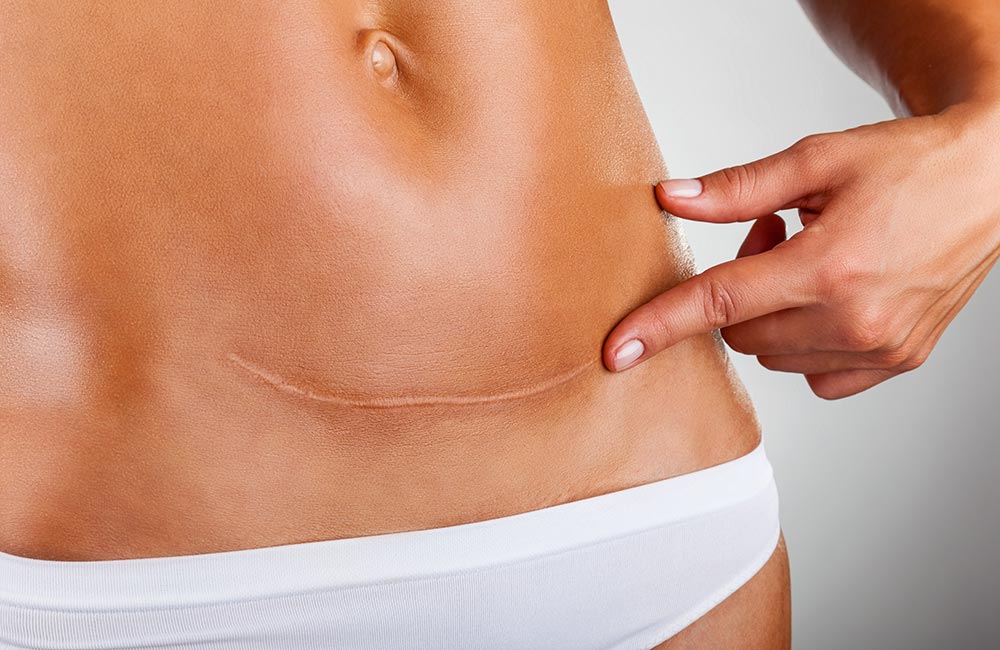 Blizny po cesarskim cięciu