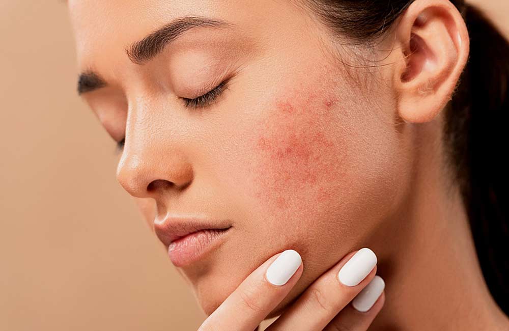 Trądzik - jakie suplementy pomogą