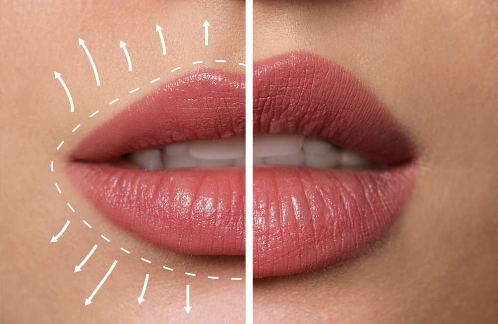 Lifting wargi górnej