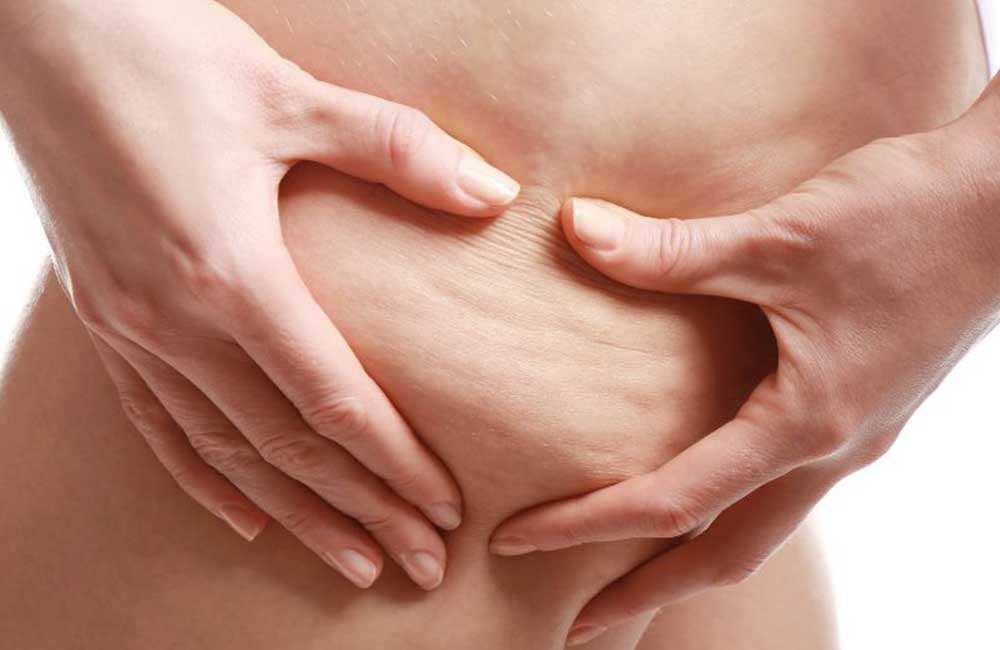 Pokochaj cellulit albo się go pozbądź!